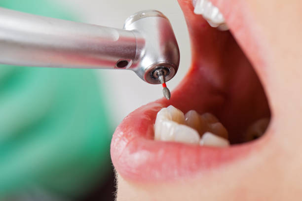 Best Emergency Wisdom Teeth Removal in Perry Hall, MD